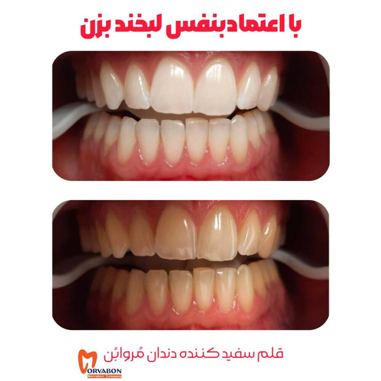مروابلیچ قلم سفید کننده دندان مروابن + دهان بازکن مروابن